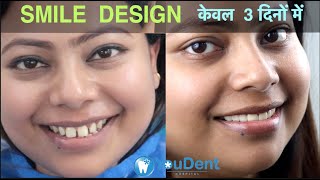 Teeth Gap Treatment in 5 Days I Zirconia Cap I Best Smile Design Dentist in INDIA youdent ​ [upl. by Gniw208]