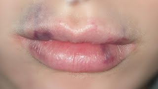 how to get rid of bruising after lip fillers tutorial [upl. by Hewes]