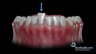 Compensatory Extrusion and Intrusion [upl. by Dazhahs661]