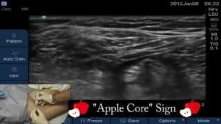 8 Popliteal Block LINK BELOW TO FULL VIDEO [upl. by Hedvig634]