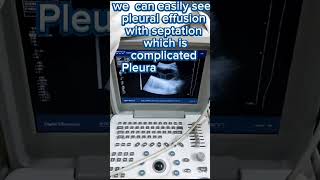 Pleural Effusion on ultrasound  ultrasound chest  complicated effusion [upl. by Llehcear360]