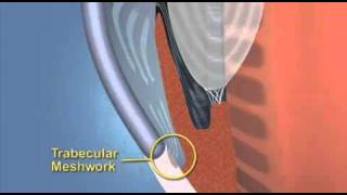 Primary Angle Closure Glaucoma Explained With Animation [upl. by Nivel282]