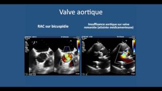 Echographie cardiaque transthoracique lessentiel a comprendre pour liECN [upl. by Rodi859]