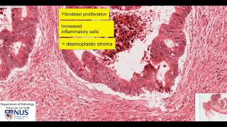 Colon carcinoma microscopy  Talking slide [upl. by Niamreg]