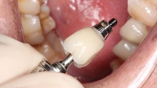 Full Contour Zirconia Implant Crown Insert [upl. by Ewen143]