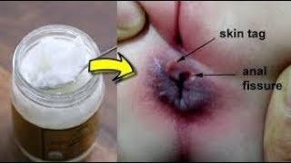 Coconut oil for hemorrhoids treatment at home Fast acting remedy [upl. by Johnathan]