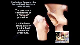 Girdlestone Procedure Hip Fractures Elderly  Everything You Need To Know  Dr Nabil Ebraheim [upl. by Rednael951]