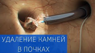 Мочекаменная болезнь удаление камней и лечение почечной колики [upl. by Cousins]