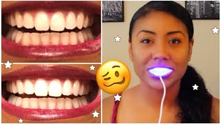 I Tried Smile Direct Teeth Whiten and THIS is What Happened 🥴 thorough review w pics [upl. by Ettennor]