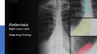 Atelectasis Right Lower Lobe Explanation of Chest Xray Findings [upl. by Asilenna628]