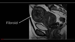 Pedunculated submucosal Fibroids [upl. by Carla392]