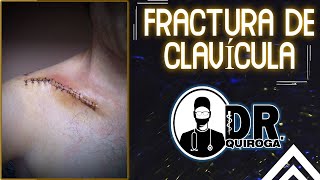 FRACTURA DE CLAVÍCULA  TRAUMATOLOGIA  Valoración clínica e imagenológica  Tipos de Fractura [upl. by Elleoj]