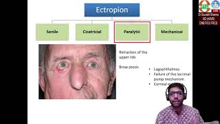 Ectropion Basics to Surgical aspects [upl. by Itida345]