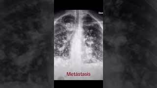 ☢️chest xray dises tb level🩻xray radiology shorts new hospital science medical [upl. by Anaert]