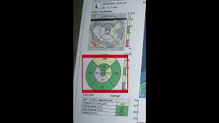 Campo Visual Analisis de Campo Unico o Campimetría computarizada y angiografia fluoresceinica 3d [upl. by Berrie]