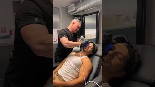 Transforming Skin with EXION RF Microneedling Chris’s Acne Scar Journey [upl. by Kolva]