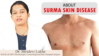 Surma Skin Disease  सुरमा कारण और उपाय   Tinea Versicolor Treatment by HealthFirst All in 1 [upl. by Keir]