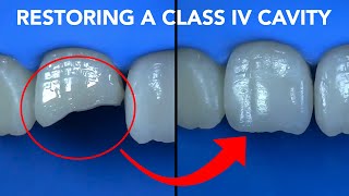 Class IV Restoration with Gaenial ACHORD [upl. by Stevena]