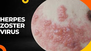 TOPICquot24HERPES ZOSTER VIRUSamp ITS CAUSES SYMPTOMS DIAGNOSIS AND TREATMENT [upl. by Eserehc]