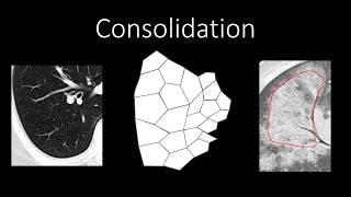 Chest Radiology  Patterns  Airspace [upl. by Seidel]