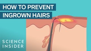 What Are Ingrown Hairs — And How To Treat Them [upl. by Von469]