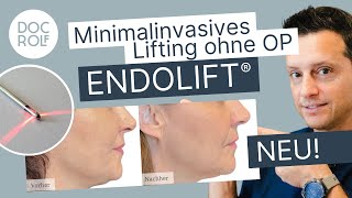 NASOLABIALFALTEN amp MARIONETTENFALTEN endlich loswerden mit dem ENDOLIFT® docrolf [upl. by Hussein]