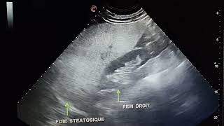 Échographie abdominale Stéatose hépatique diffuse Hepatomegalie FH a 215 mm [upl. by Kobylak]