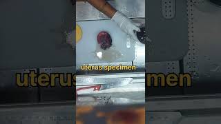 Uterus specimen grossing tissuefixation kidneydisorder cystickidneydisease [upl. by Mortimer]