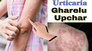 pitti uchalne par kya karte hain  urticaria ayurvedic treatment in hindi  pitti ka gharelu ilaj [upl. by Ahsemaj]