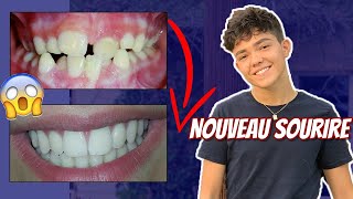 TOUT SUR MES DENTS évolution douleurs [upl. by Linden]