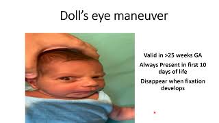 Dolls Eye Maneuver  Pediatrics [upl. by Stutsman854]