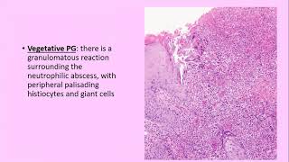 Lecture99 Neutrophilic Dermatoses Pyoderma Gangrenosum amp Sweets syndrome PartI Rooks Ch 49 [upl. by Yssak838]