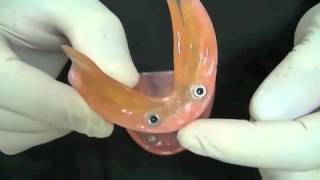 Prótese sobre implante  Overdenture [upl. by Keare]