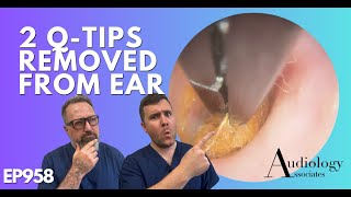 2 QTIPS REMOVED FROM EAR  EP958 [upl. by Ludba]