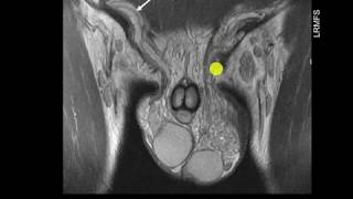 Varicocele testicular como diagnosticar [upl. by Krantz]