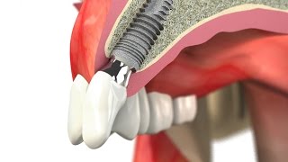 SIC invent Dental Implant WaxUp Single Tooth Crown [upl. by Nylkaj]