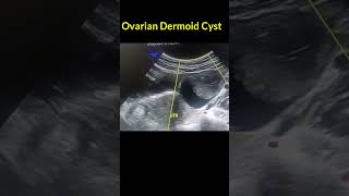 OVARIAN CYSTIC TERATOMA DERMOID CYST [upl. by Drawde]