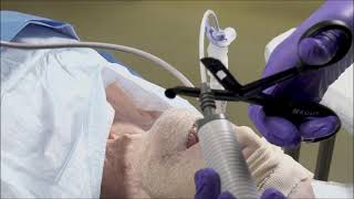 Flexible bronchoscopeguided endotracheal intubation via an igel [upl. by Hervey]