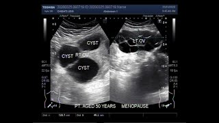 Screening of Ovarian Cancer [upl. by Akila]