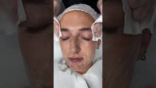 Benefits of Mandelic Acid Skin Peels  Dr Medispa [upl. by Misty]