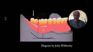 Leave off the second molars for complete dentures [upl. by Esyahc296]