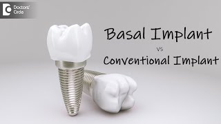 Comparison between basal and Conventional Implants  Dr Shahul HameedDoctors Circle [upl. by Toms606]