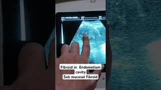 Endometrium fibroid sub mucosal shortyoutubevideo loveultrasound pregnant pregnant [upl. by Elinad402]