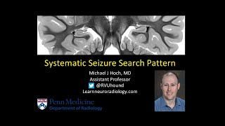 Chase 16 month old myoclonic seizure [upl. by Dorsman]