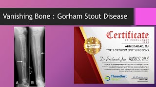 Gorhams Stout Disease  Vanishing Bone Disease Lymph Vessels into bone [upl. by Boj]