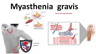 Neurology  Topic 20  Myasthenia gravis and Ptosis [upl. by Katrinka245]