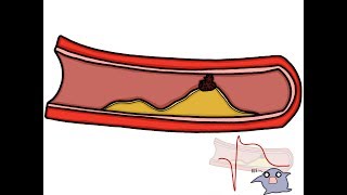 Ateromatosis e infartos Dr Huge Stat [upl. by Aynotahs]