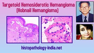 Pathology of Targetoid Hemosiderotic Hemangioma Hobnail Hemangioma  Dr Sampurna Roy MD [upl. by Dlonra]