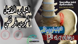 التهاب المفصل العجزي الحرقفي  والفرق بينه وبين عرق النسا  Sacroiliitis  SI joint dysfunction [upl. by Atauqal]