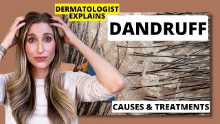 Dermatologist Explains Dandruff What Causes it amp Best Dandruff Treatments  Dr Sam Ellis [upl. by Annahpos]